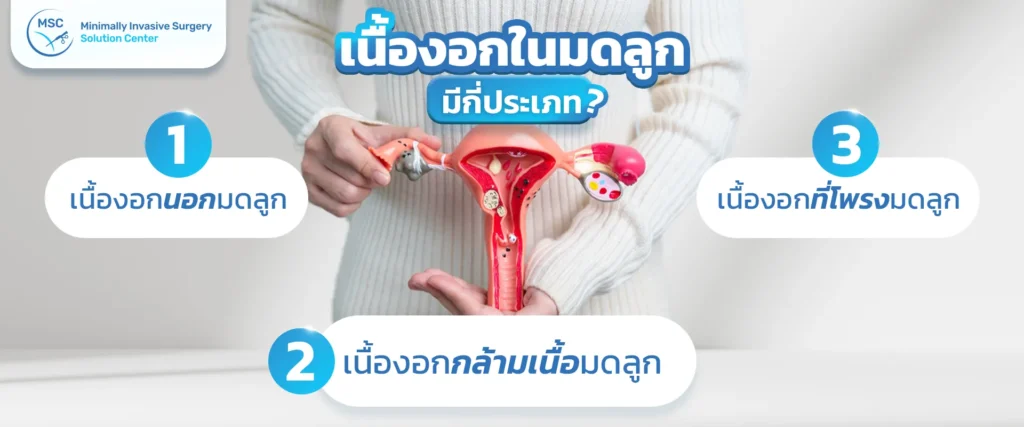 ประเภทของเนื้องอกในมดลูก