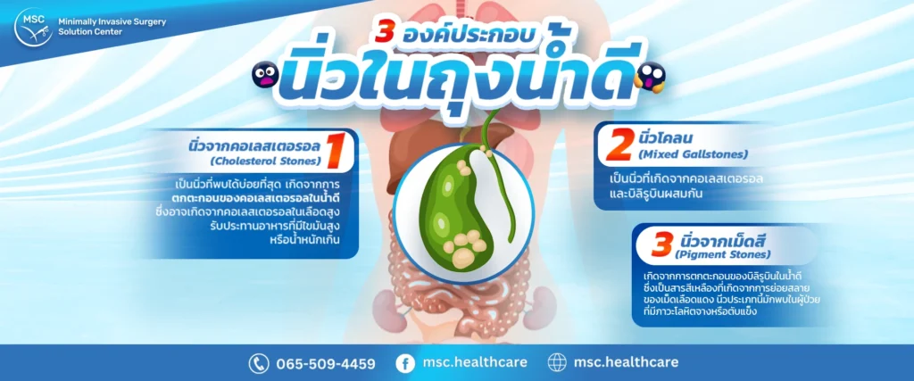 องค์ประกอบนิ่วในถุงน้ำดี