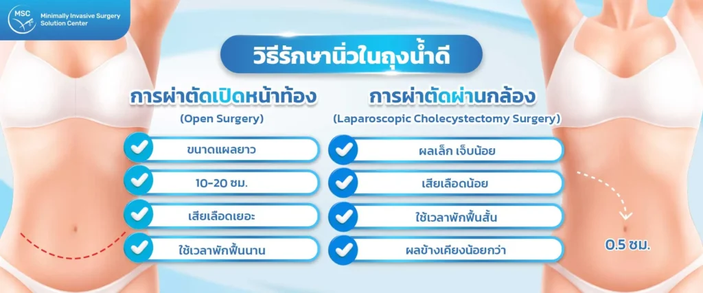 วิธีรักษานิ่วในถุงน้ำดี