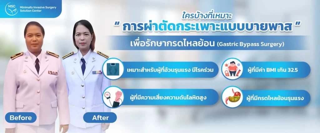 ใครบ้างที่เหมาะกับการผ่าตัดกระเพาะแบบบายพาสเพื่อรักษากรดไหลย้อน
