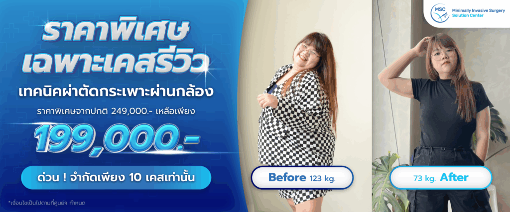 โปรโมชัน เคสรีวิวผ่าตัดกระเพาะ 199,000