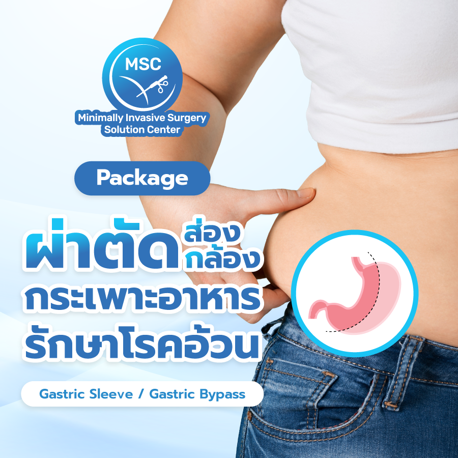 แพ็กเกจผ่าตัดกระเพาะอาหารส่องกล้องรักษาโรคอ้วน